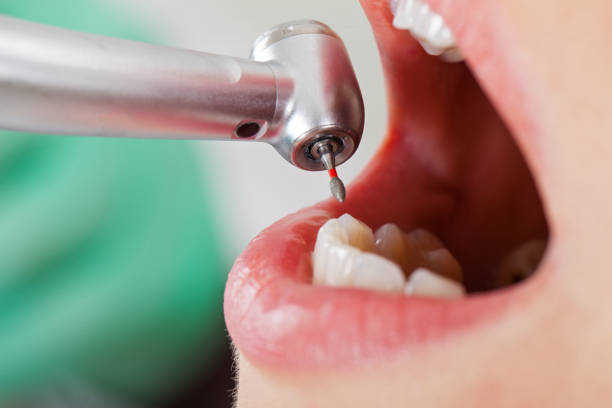 Best Emergency Wisdom Teeth Removal in Eatontown, NJ